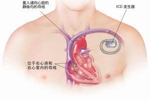 巴掌马vs英格兰-1-战胜死神！埃里克森植入的ICD是什么？还能从事高强度的运动吗？